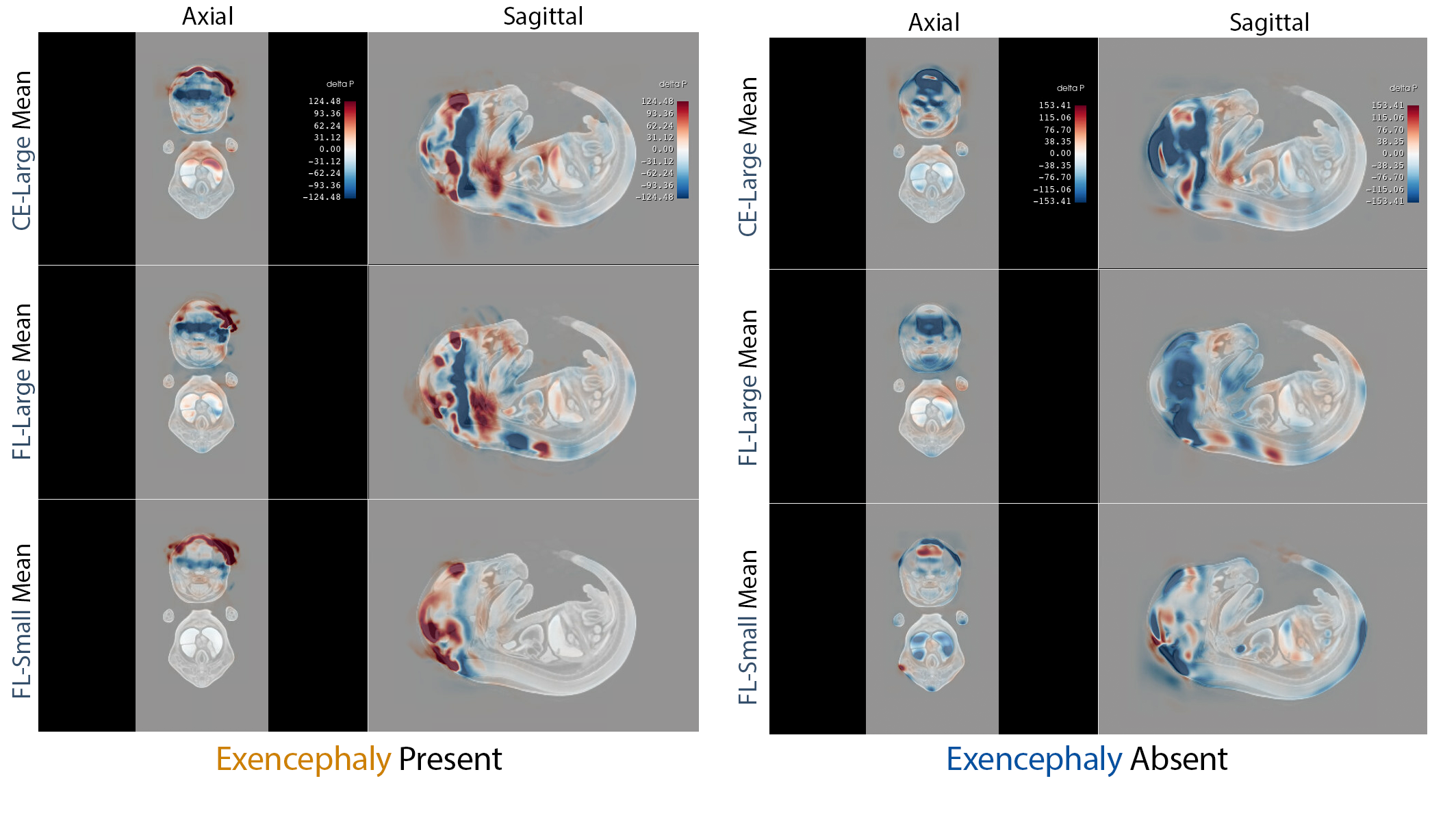 Ensemble‑averaged attribution maps highlight the malformed cranial vault in positive and negative cases and suppress off‑target signal; focal loss lowers saliency entropy and boosts cross‑seed Dice/Jaccard.